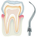 Удаление зубного камня Удаление зубного камня